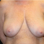 Breast Lift Before & After Patient #29177