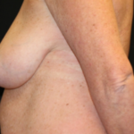 Breast Lift Before & After Patient #29177