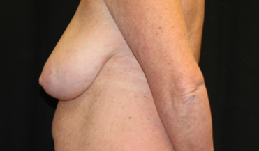 Breast Lift Before & After Patient #29177