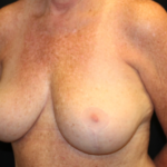 Breast Lift Before & After Patient #29177