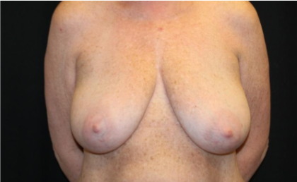 Breast Lift Before & After Patient #29177