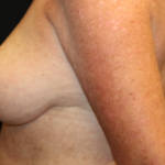 Breast Lift Before & After Patient #29177