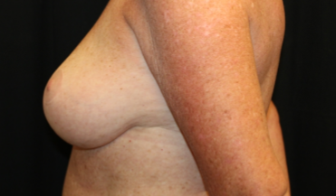 Breast Lift Before & After Patient #29177