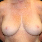 Breast Lift Before & After Patient #29177