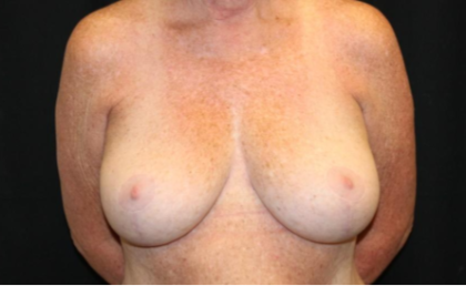 Breast Lift Before & After Patient #29177