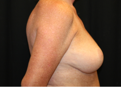 Breast Lift Before & After Patient #29177