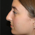 Rhinoplasty Before & After Patient #29278