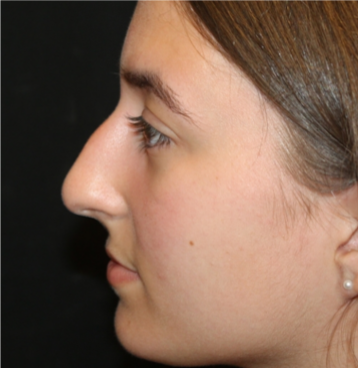 Rhinoplasty Before & After Patient #29278