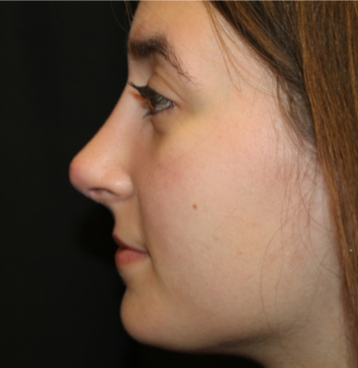 Rhinoplasty Before & After Patient #29278