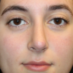 Rhinoplasty Before & After Patient #29278