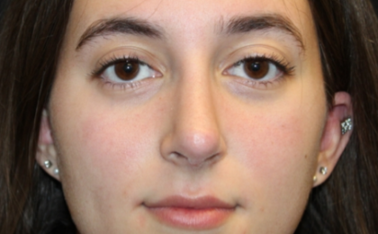 Rhinoplasty Before & After Patient #29278