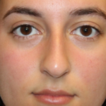 Rhinoplasty Before & After Patient #29278