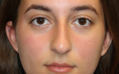 Rhinoplasty Before & After Patient #29278