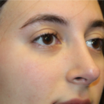 Rhinoplasty Before & After Patient #29278