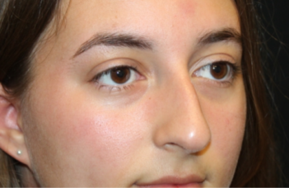 Rhinoplasty Before & After Patient #29278