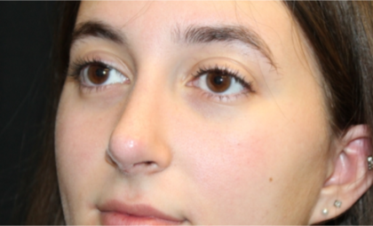 Rhinoplasty Before & After Patient #29278