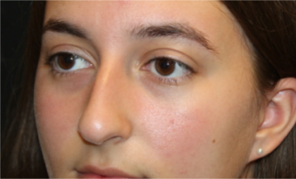 Rhinoplasty Before & After Patient #29278