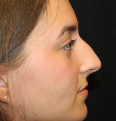 Rhinoplasty Before & After Patient #29278