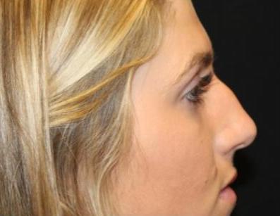 Rhinoplasty Before & After Patient #29206