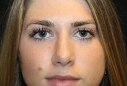 Rhinoplasty Before & After Patient #29206