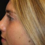 Rhinoplasty Before & After Patient #29206