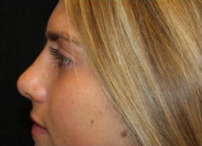 Rhinoplasty Before & After Patient #29206