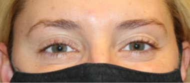 Botox and Dysport Before & After Patient #29291