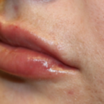 Lip Filler Before & After Patient #29263