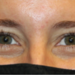 Botox and Dysport Before & After Patient #29291