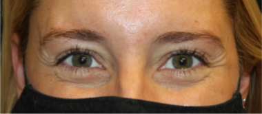 Botox and Dysport Before & After Patient #29291