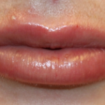 Lip Filler Before & After Patient #29263