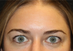 Botox and Dysport Before & After Patient #29268