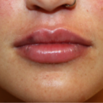 Lip Filler Before & After Patient #29273