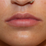 Lip Filler Before & After Patient #29273