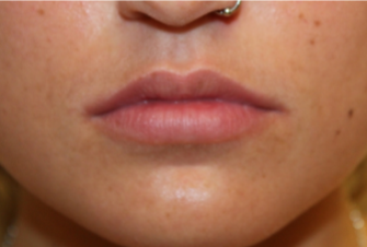 Lip Filler Before & After Patient #29273