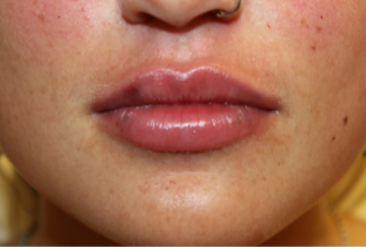 Lip Filler Before & After Patient #29273