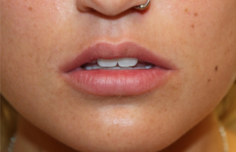 Lip Filler Before & After Patient #29273