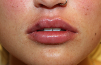 Lip Filler Before & After Patient #29273