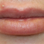 Lip Filler Before & After Patient #29263