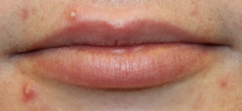 Lip Filler Before & After Patient #29263