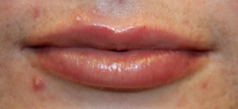 Lip Filler Before & After Patient #29263