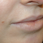 Lip Augmentation Before & After Patient #29304