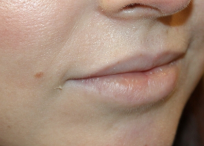 Lip Augmentation Before & After Patient #29304