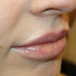 Lip Augmentation Before & After Patient #29304