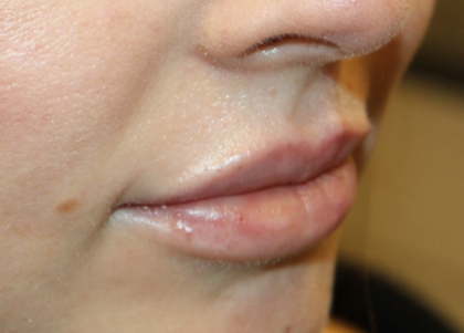 Lip Augmentation Before & After Patient #29304