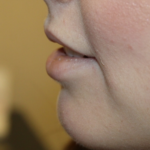 Lip Augmentation Before & After Patient #29304