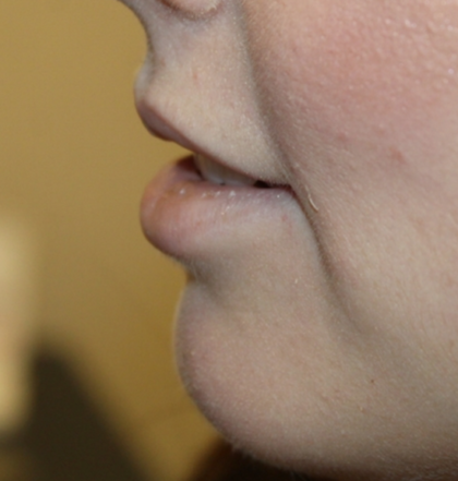 Lip Augmentation Before & After Patient #29304