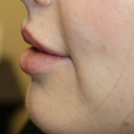 Lip Augmentation Before & After Patient #29304