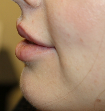 Lip Augmentation Before & After Patient #29304