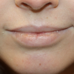 Lip Augmentation Before & After Patient #29304